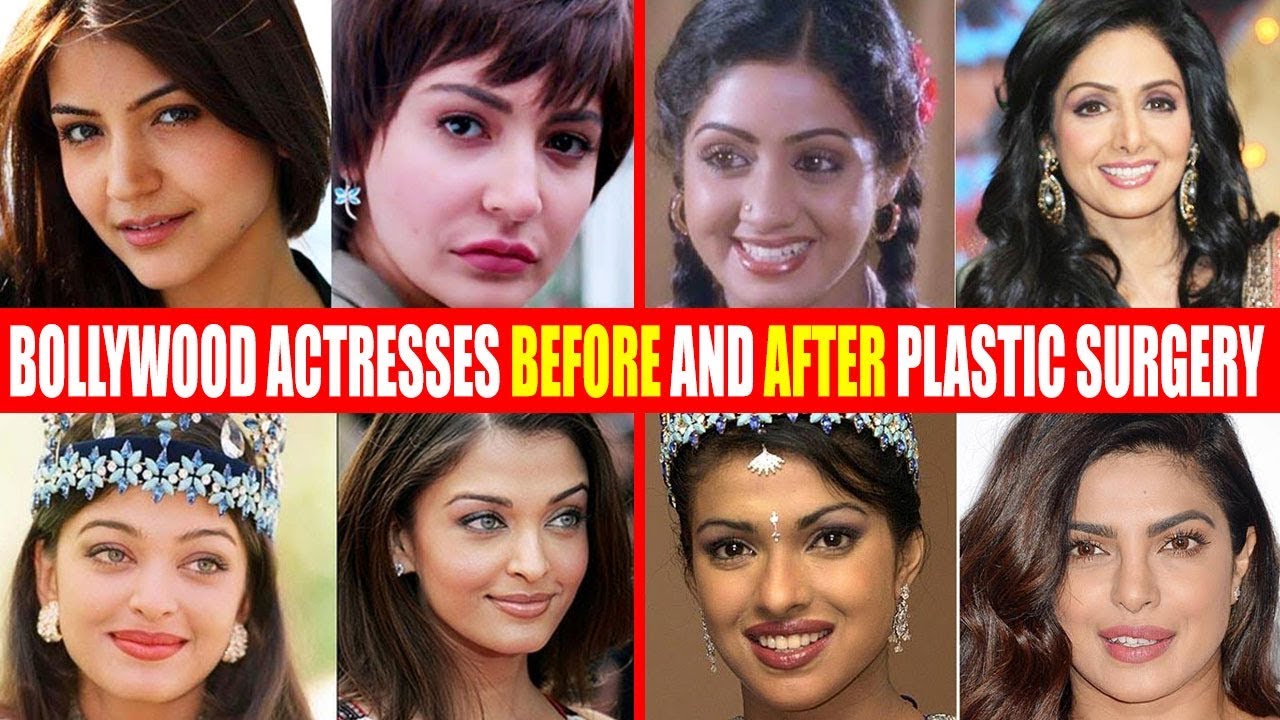 Bollywood Actors Before and After Plastic Surgery – Shocking Transformations